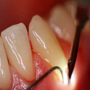 Лечение клиновидных дефектов зубов спб thumbnail