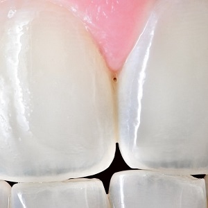 Почему эмаль зубов становится прозрачной?