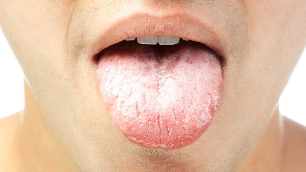 Белый налет на языке у взрослых – причины, признак какого заболевания?