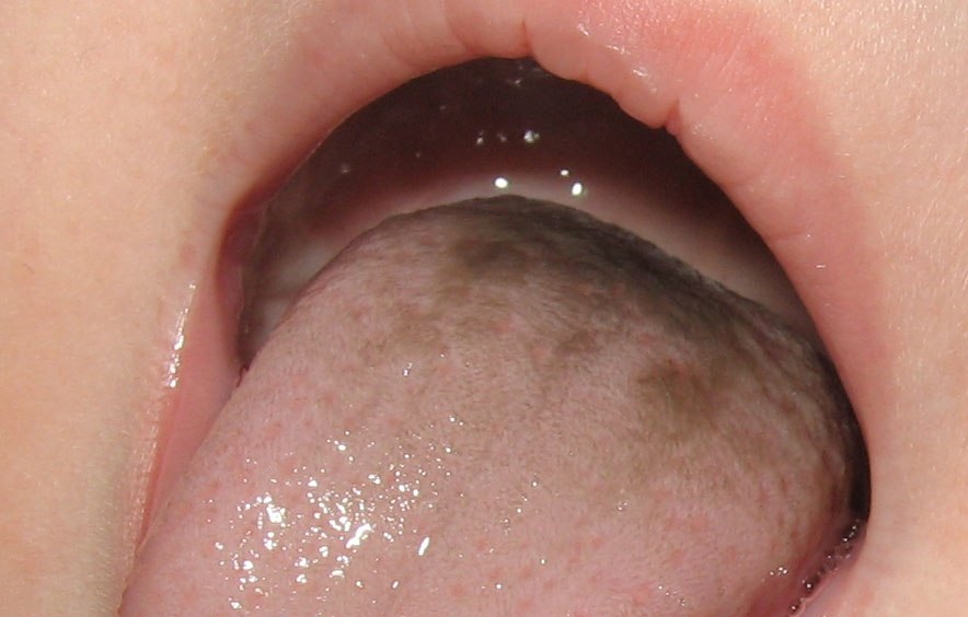 Причины желтого налета на языке у взрослых: симптомы возможных заболеваний и лечение желтизны