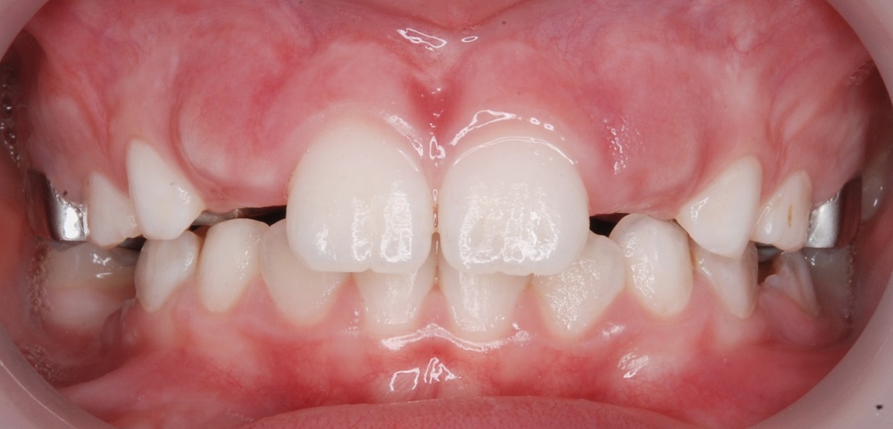 Когда выпадают молочные зубы у детей?