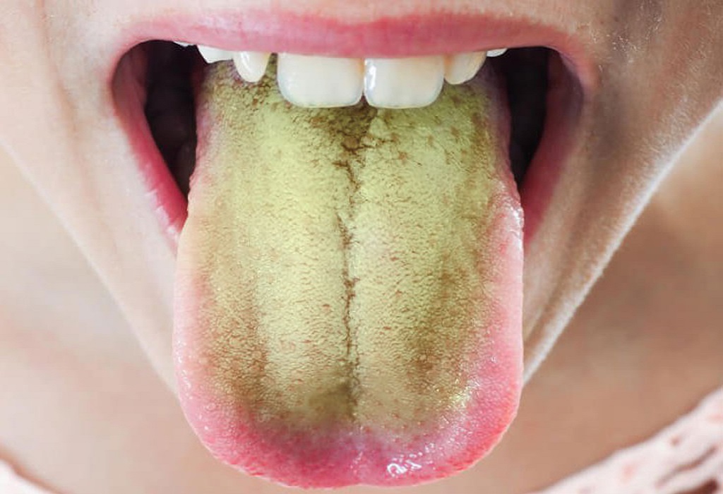 Зеленый налет на языке при ангине