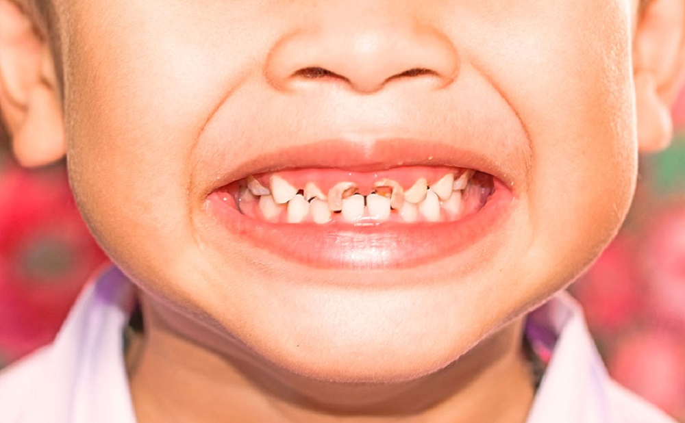 Желтые зубы: причины возникновения и способы лечения