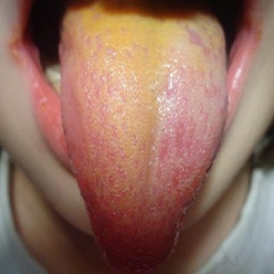Желтый налет на языке у ребенка – Причины появления желтого налета на языке у грудничка