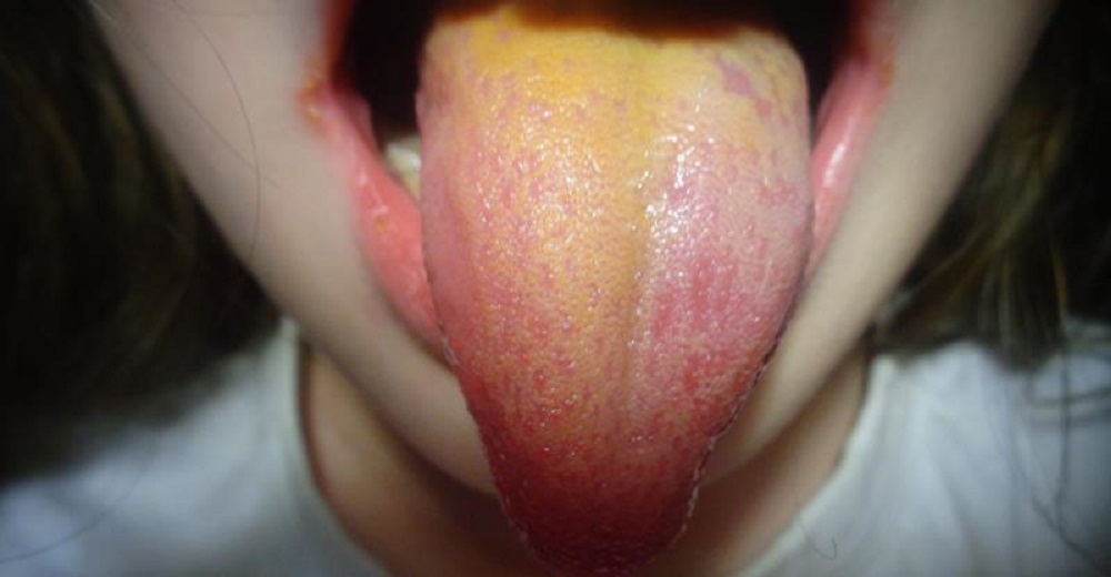 Желтый налет на языке у ребенка – Причины появления желтого налета на языке у грудничка