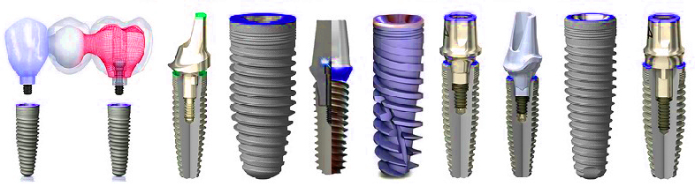 Лучшие корейские импланты. Имплантат Nobel типы имплантов. Имплантаты корневидной формы. Разборные и неразборные дентальные имплантаты. Бренды зубные импланты.