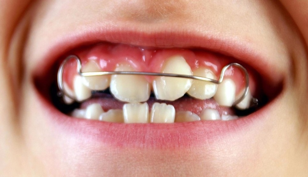 Причины, по которым у детей растут кривые зубы