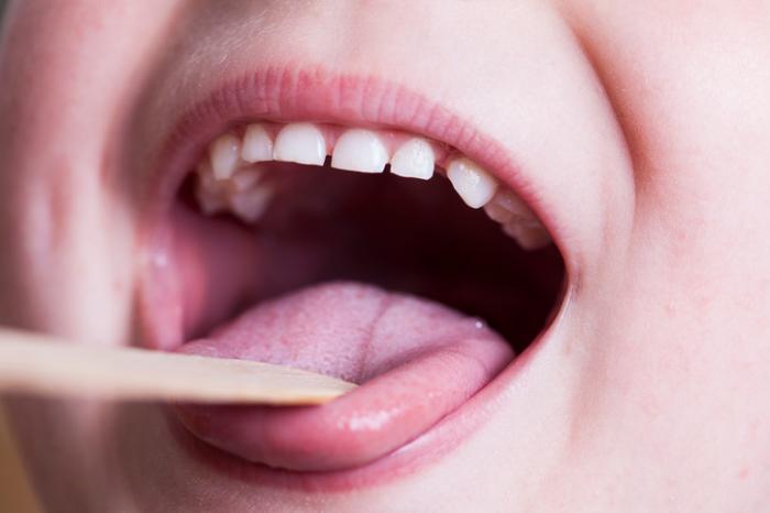 У ребенка болит горло и белый язык: что предпринять?