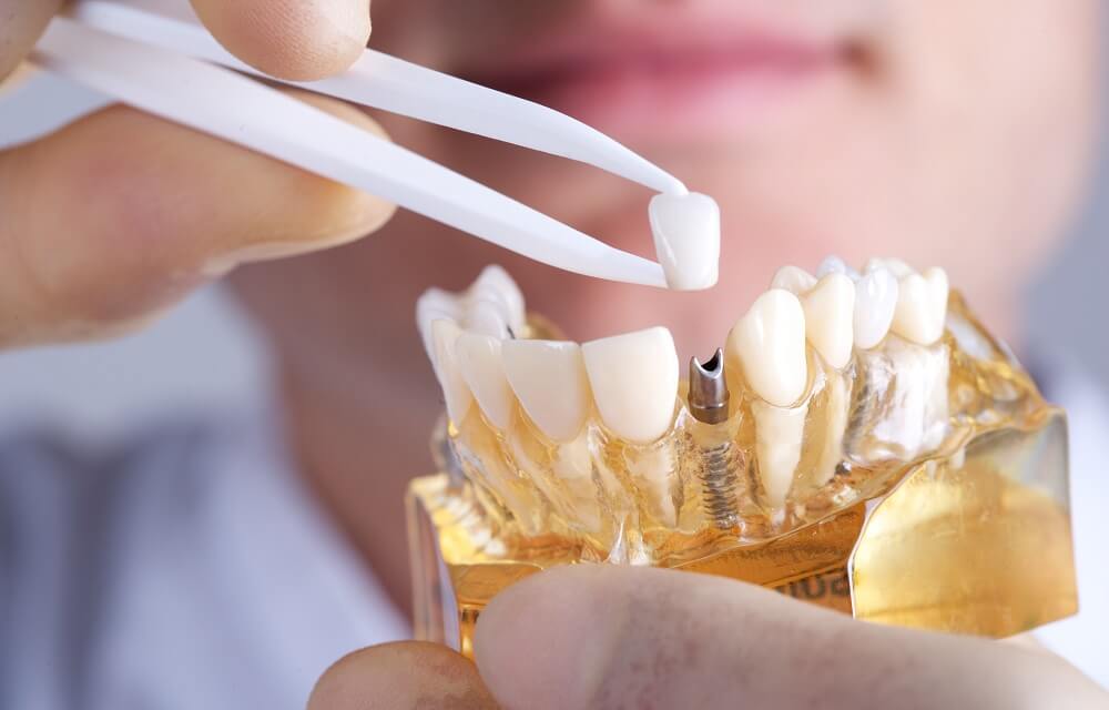 Материалы для протезирования зубов что лучше