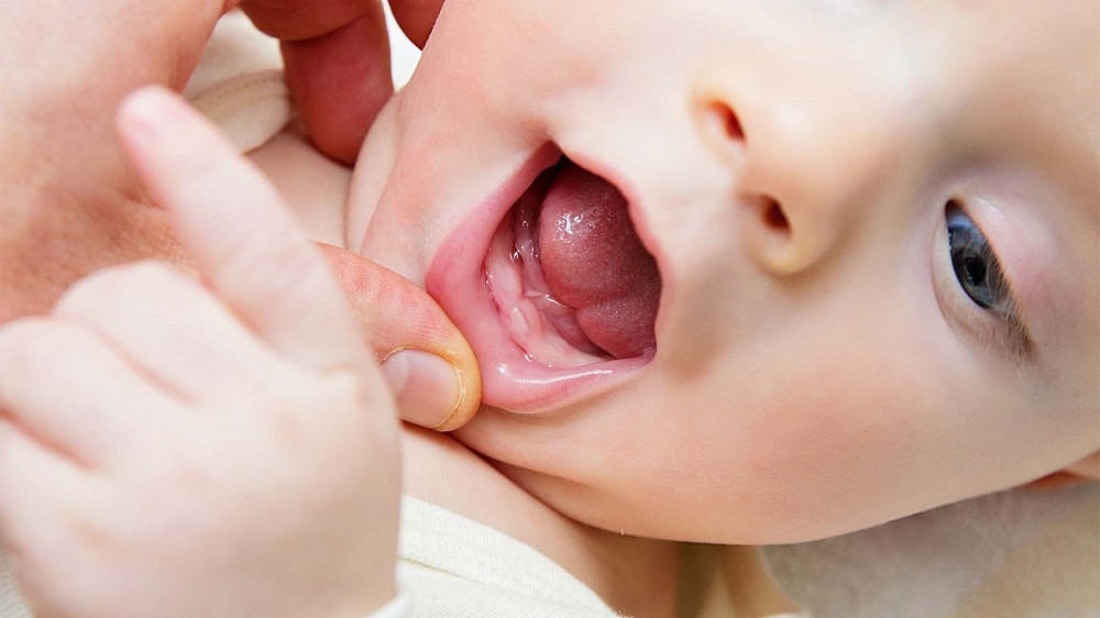 Молочница у новорожденных во рту – симптомы