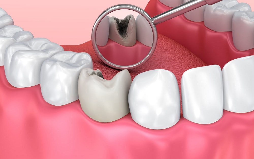 Почему выпадают зубы у взрослого человека лечение