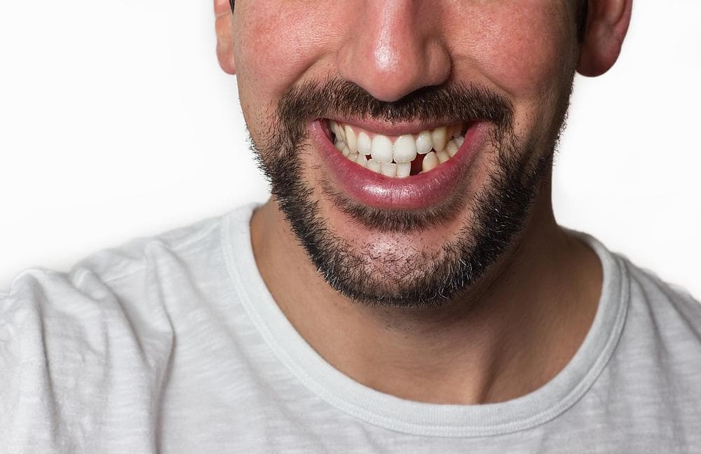 Почему выпадают зубы у взрослого человека лечение