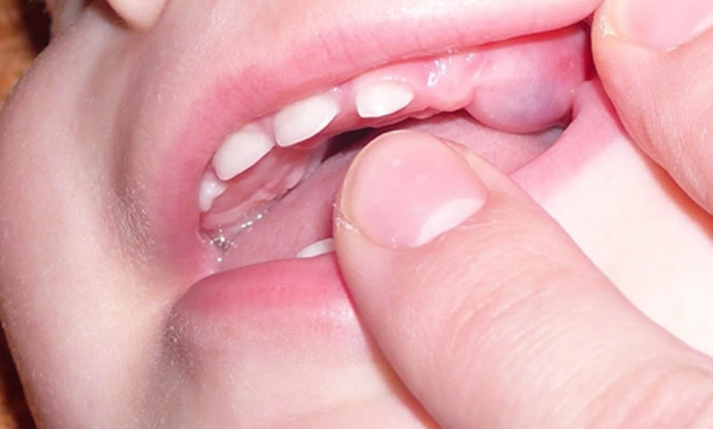 Клыки у ребенка — когда лезут | Прорезывание верхних и нижних «глазных» зубов