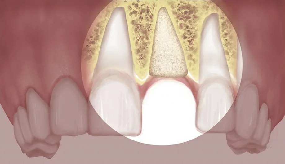 Смещение зубов после удаления зуба лечение