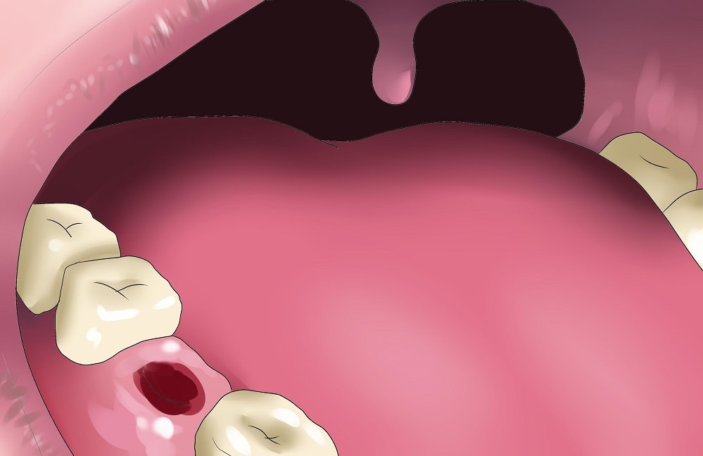 Гранулема зуба: причины и лечение заболевания