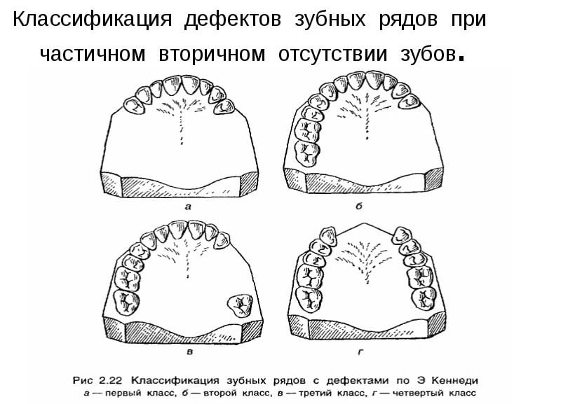 Отсутствие дефектов. Подклассы дефектов зубных рядов по Кеннеди. Классификация дефектов зубных рядов Кеннеди. Классификация дефектов по Кеннеди с ПОДКЛАССАМИ. 2 Класс 1 подкласс по Кеннеди.