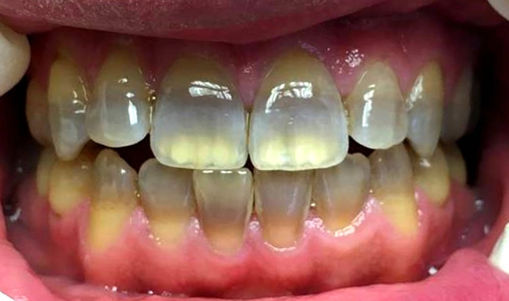 Отбеливание зубов ZOOM-3